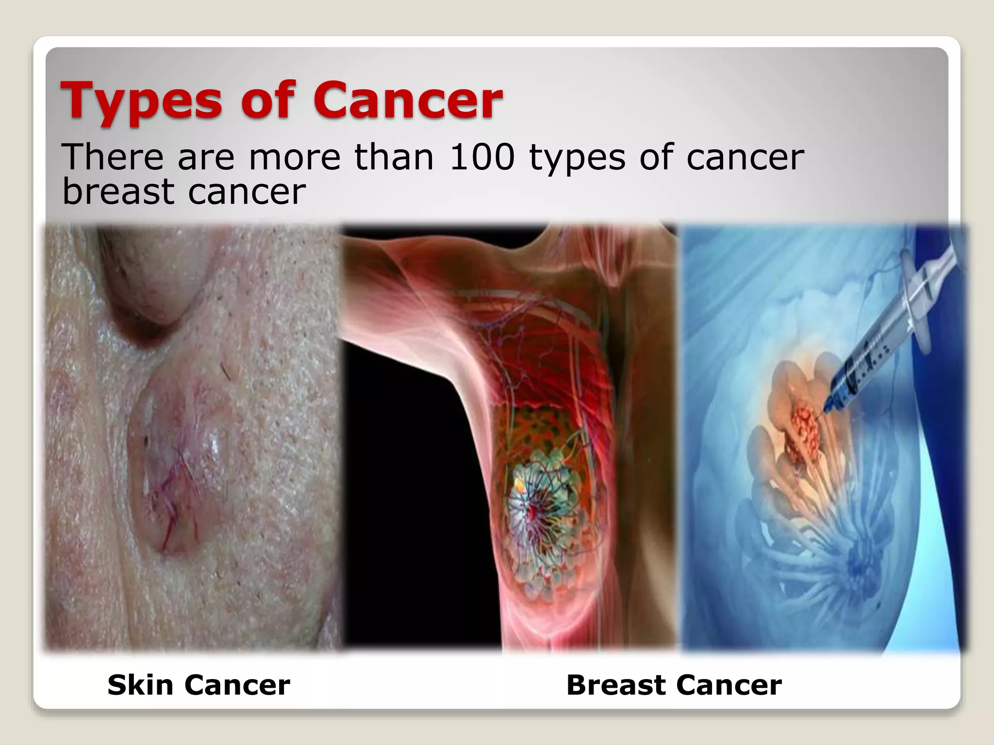 Types of Cancer
There are more than 100 types of cancer
breast cancer
Skin Cancer Breast Cancer
 