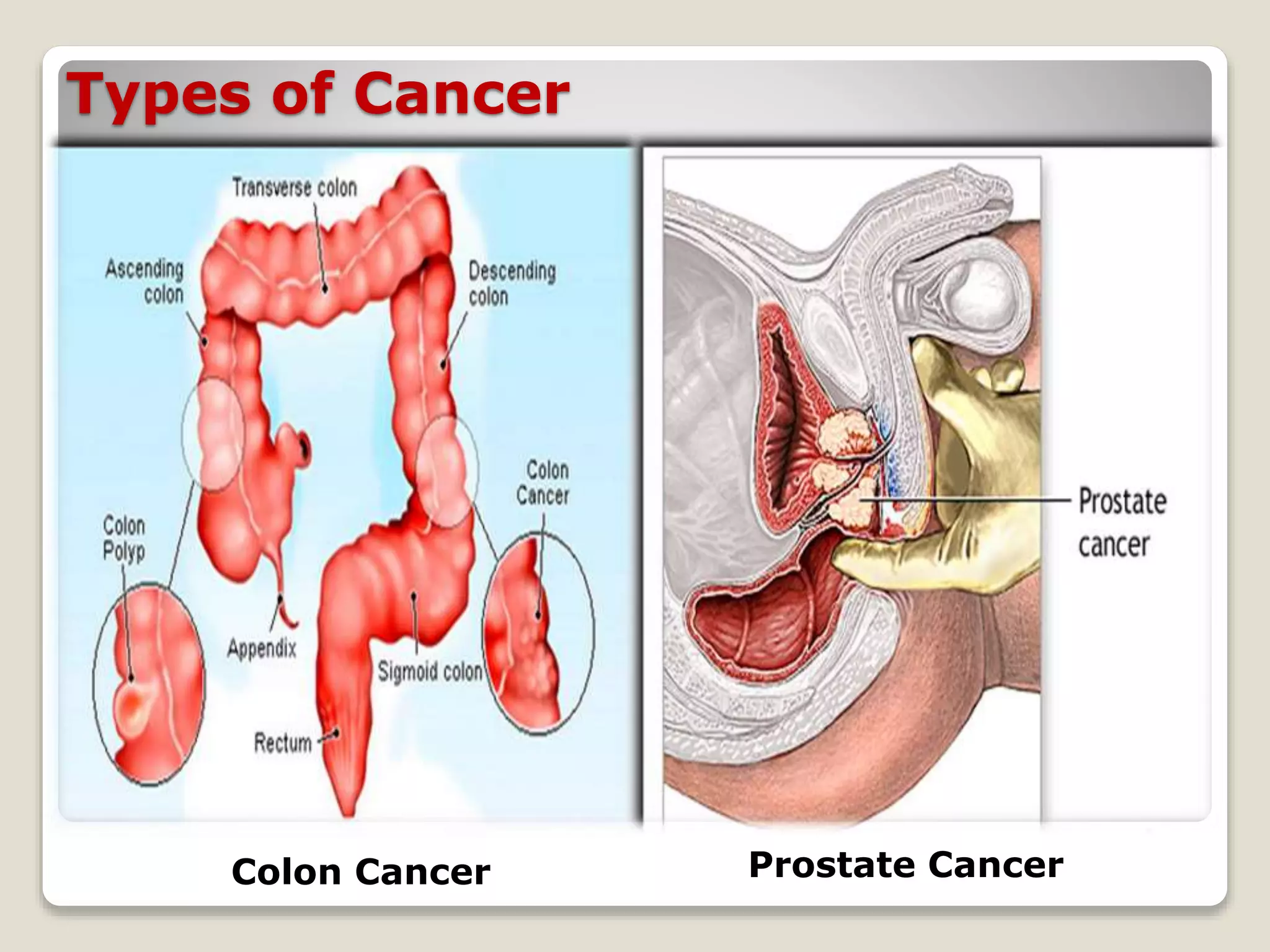 Types of Cancer
Colon Cancer Prostate Cancer
 