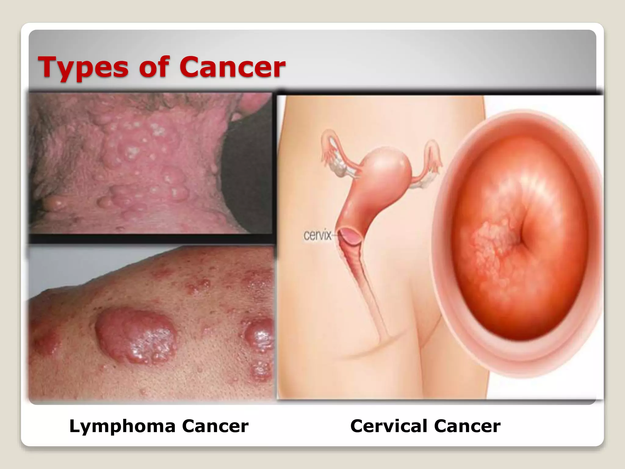 Types of Cancer
Lymphoma Cancer Cervical Cancer
 