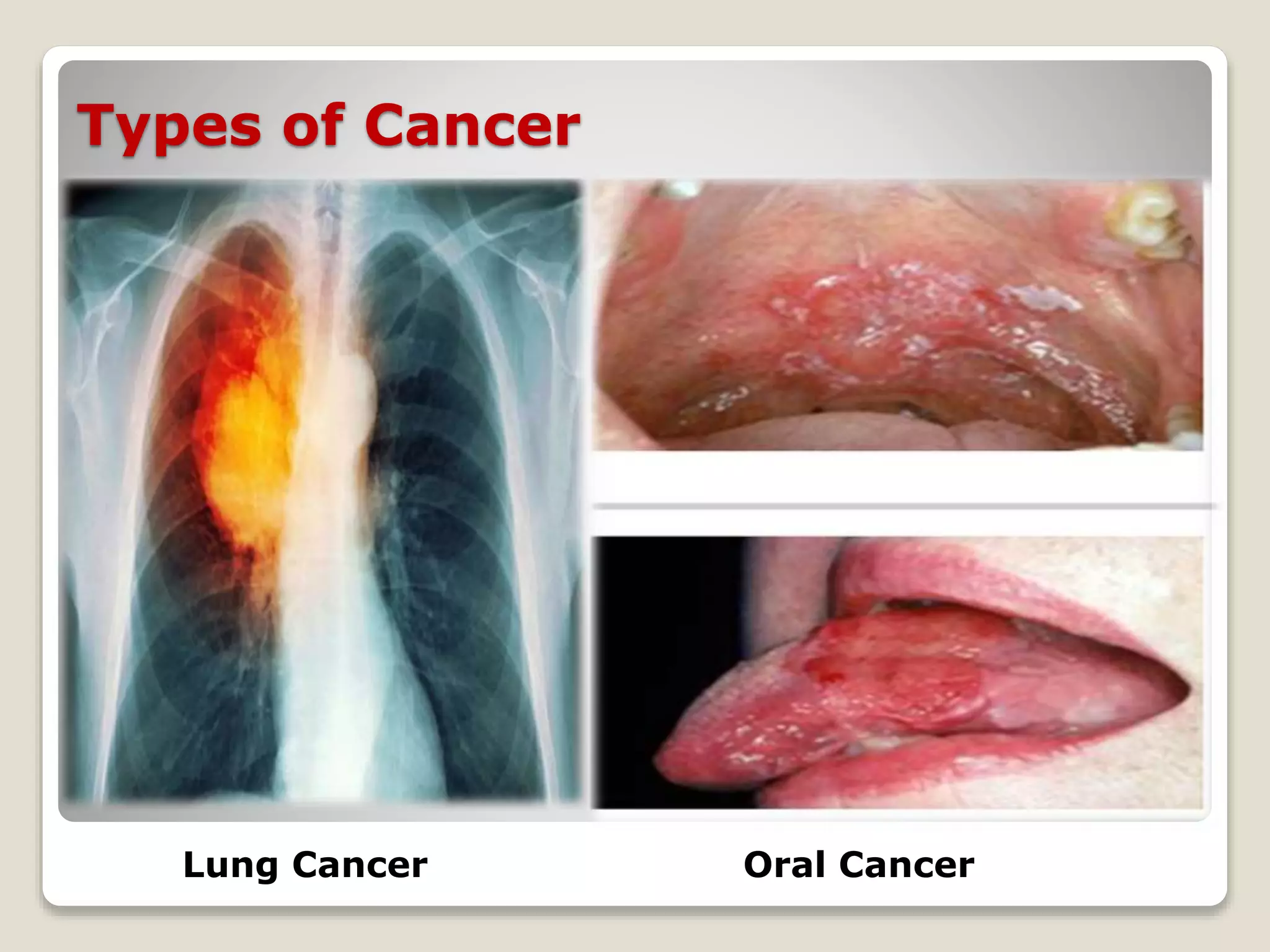 Types of Cancer
Lung Cancer Oral Cancer
 