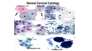 Normal Cervical Cytology
Metaplastic cells
Endometrial cells
 