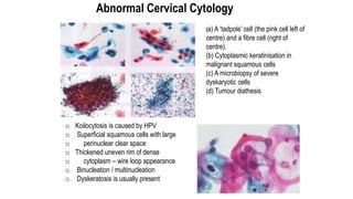 Abnormal Cervical Cytology
(a) A ‘tadpole’ cell (the pink cell left of
centre) and a fibre cell (right of
centre).
(b) Cyt...