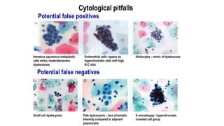 Cytological pitfalls
Potential false positives
Immature squamous metaplastic
cells mimic moderate/severe
dyskeratosis
Endo...