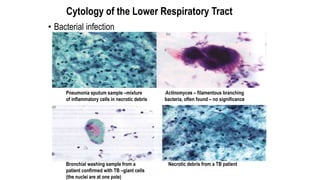 Cytology of the Lower Respiratory Tract
• Bacterial infection
Pneumonia sputum sample –mixture
of inflammatory cells in ne...