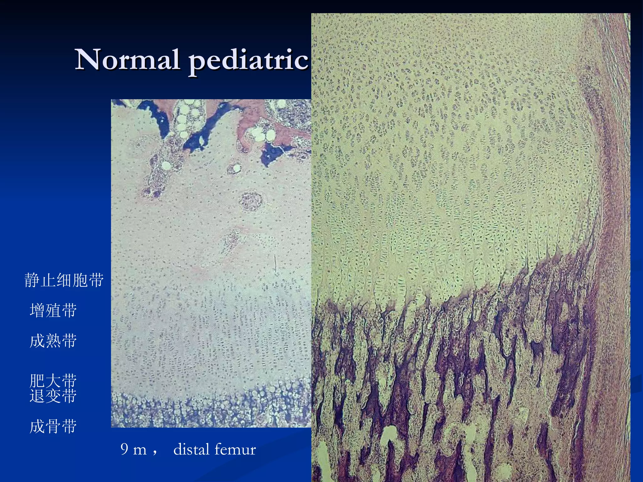 Normal pediatric X-ray appearances 9 m ， distal femur 增殖带 成熟带 肥大带 退变带 成骨带 静止细胞带 { 