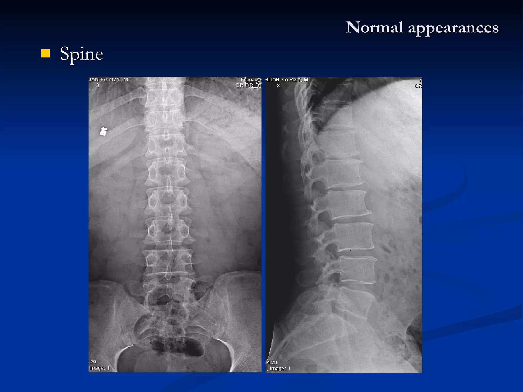 Spine  Normal appearances 
