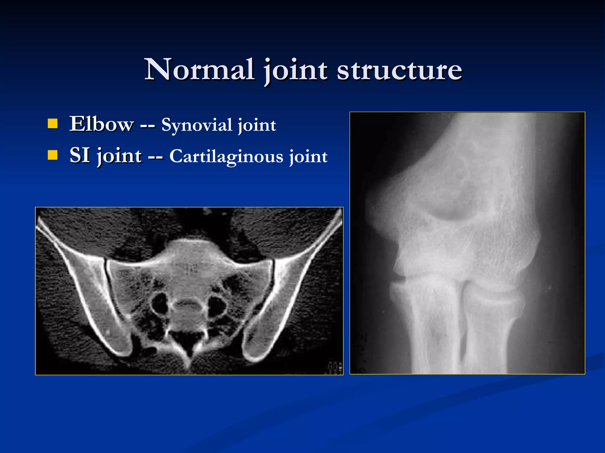 Normal joint structure Elbow --  Synovial joint   SI joint --  Cartilaginous joint 