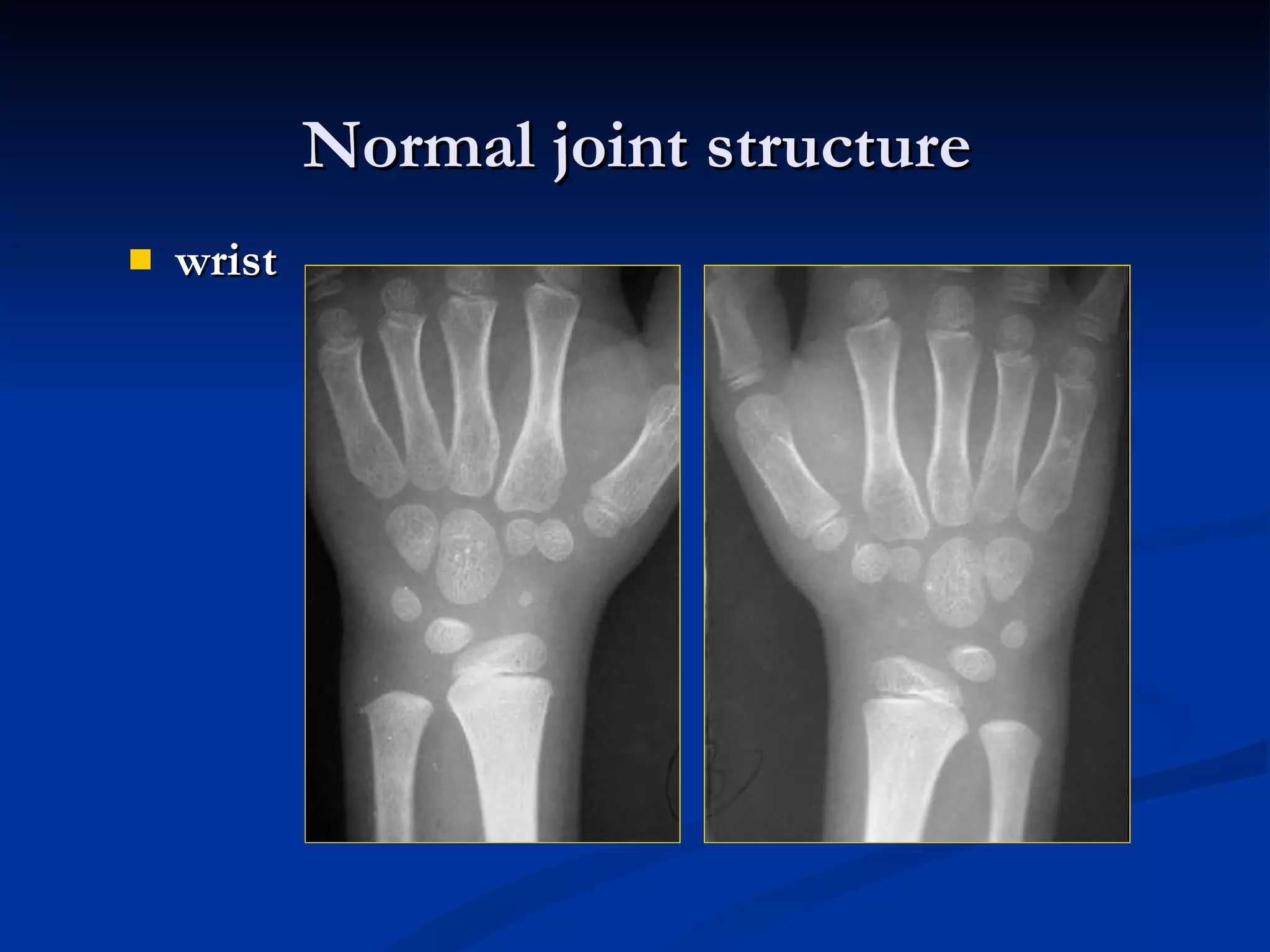 wrist Normal joint structure 