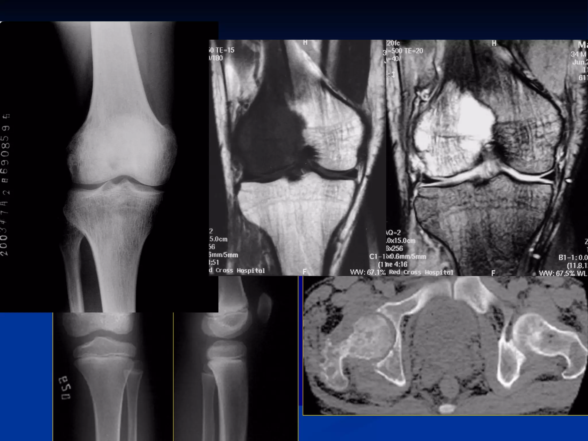 Imaging technology X-ray ： plain film   Very good X-ray density resolution in bone & joint ， the resolution of soft tissue not enough CT ： as X-ray,  but good for positioning MR ： advantage ： very good soft tissue resolution disadvantage ： not sensitivity to display calcification US ： Non-invasive image method, easy to perform Can evaluate the soft tissue abnormalities 