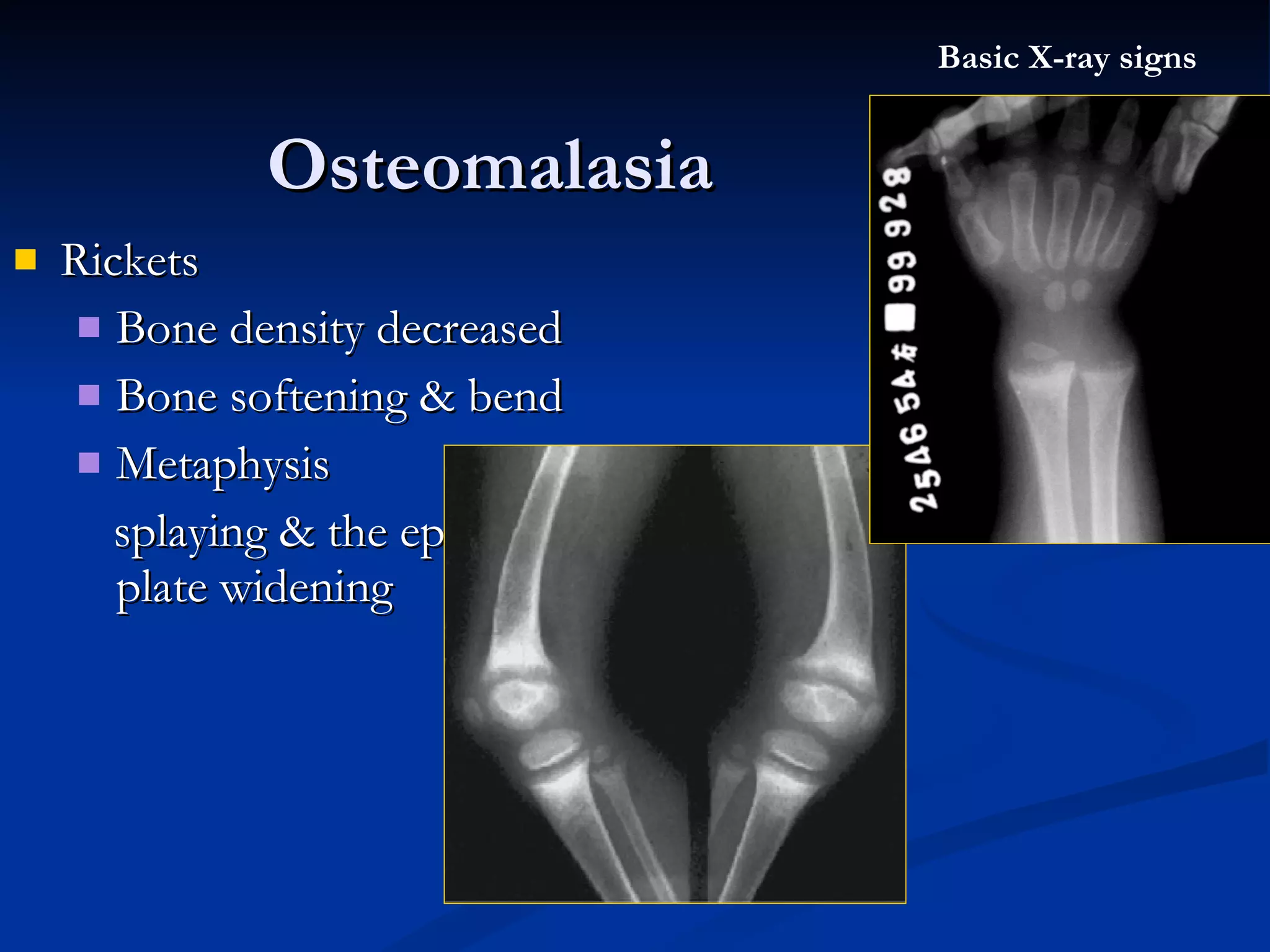 Rickets  Bone density decreased Bone softening & bend Metaphysis  splaying & the epiphyseal plate widening Osteomalasia Basic X-ray signs 