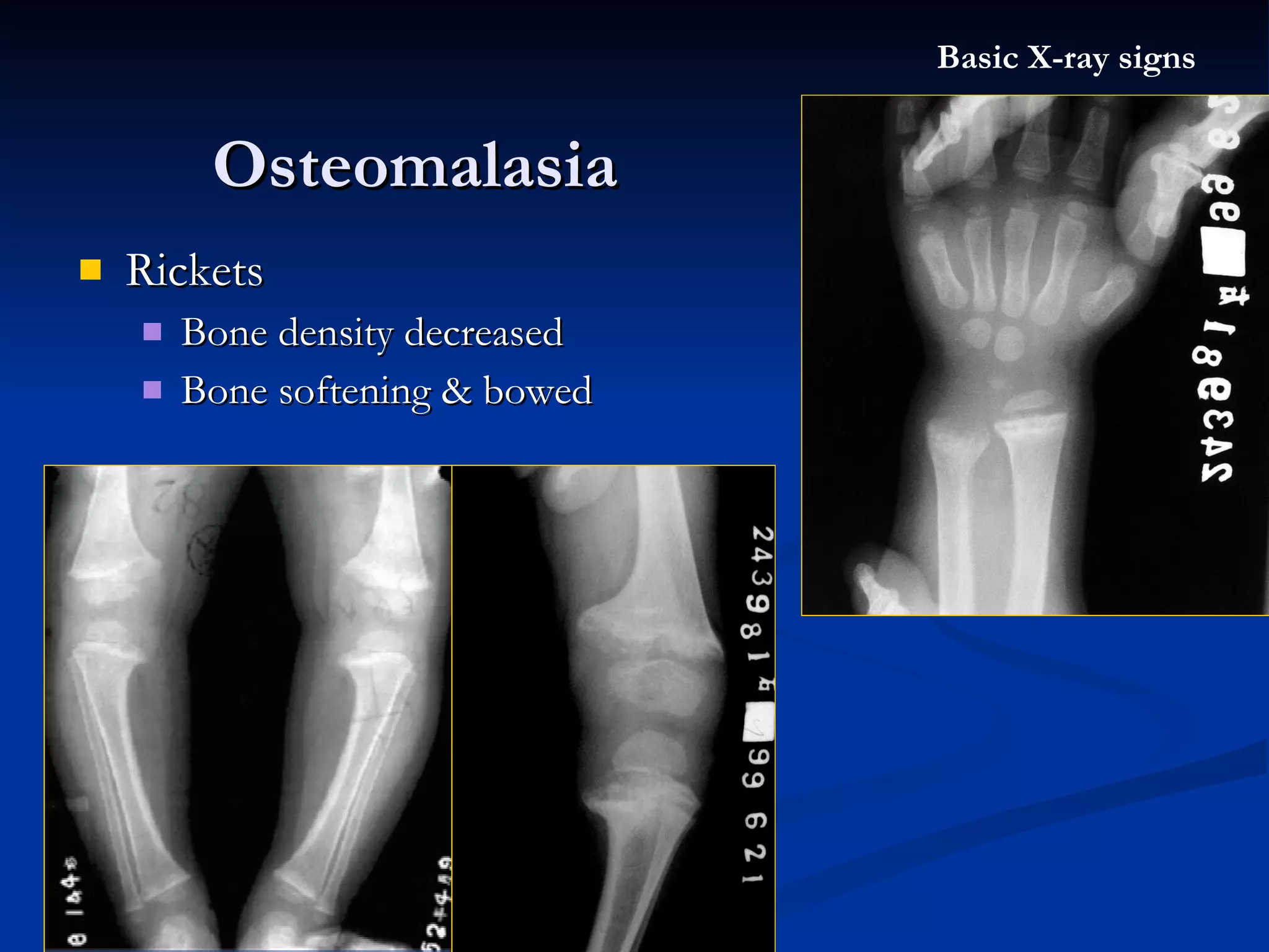 Rickets  Bone density decreased Bone softening & bowed Osteomalasia Basic X-ray signs 