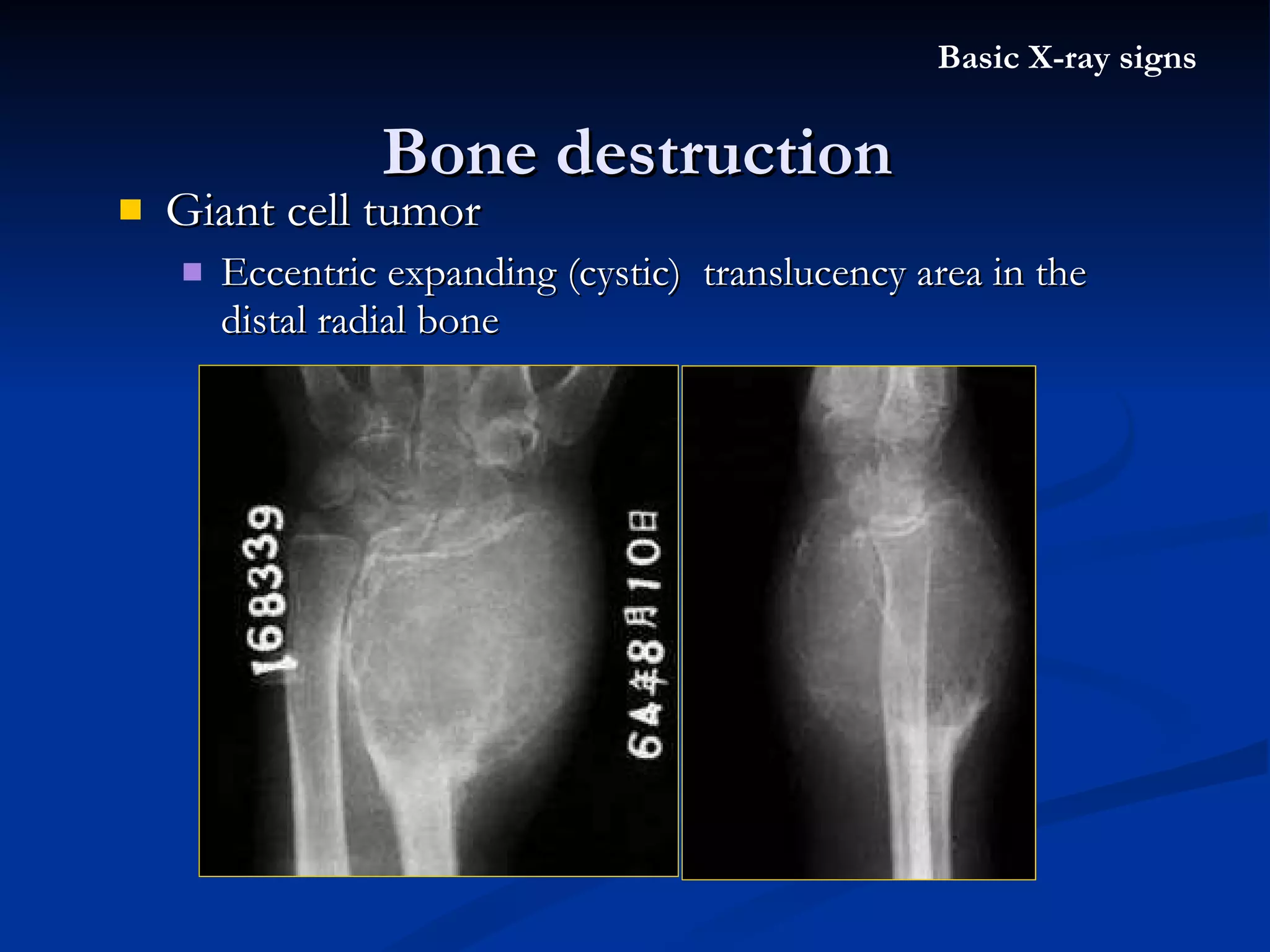 Giant cell tumor Eccentric expanding (cystic)  translucency area in the distal radial bone Bone destruction Basic X-ray signs 