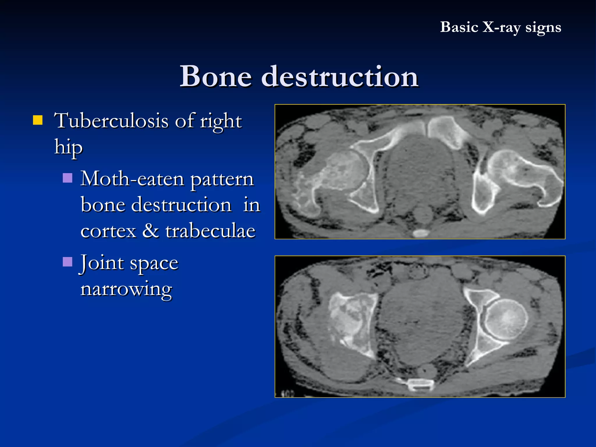 Tuberculosis of right hip Moth-eaten pattern bone destruction  in cortex & trabeculae Joint space narrowing Bone destruction Basic X-ray signs 