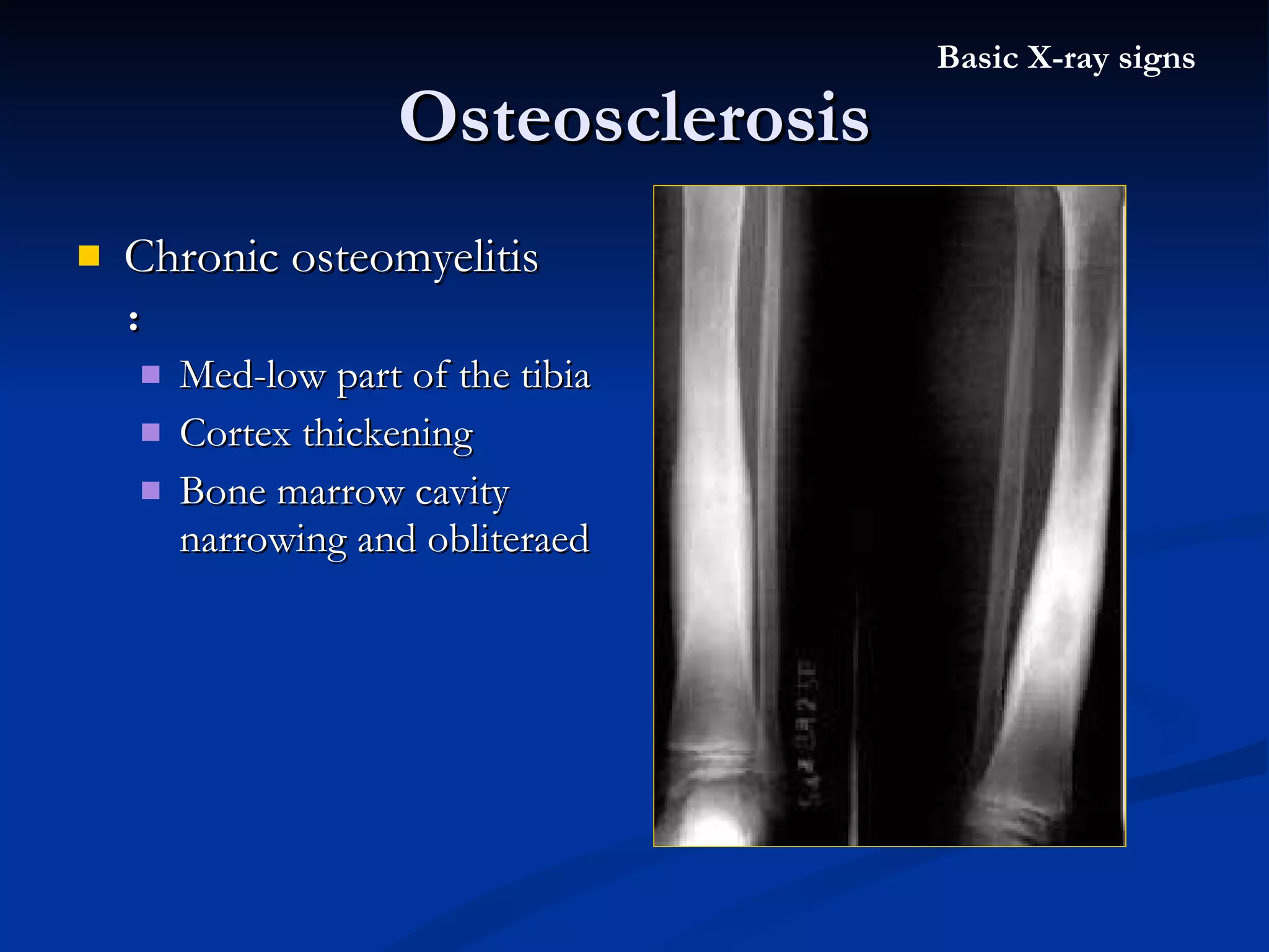 Chronic osteomyelitis  ： Med-low part of the tibia  Cortex thickening Bone marrow cavity narrowing and obliteraed Osteosclerosis Basic X-ray signs 
