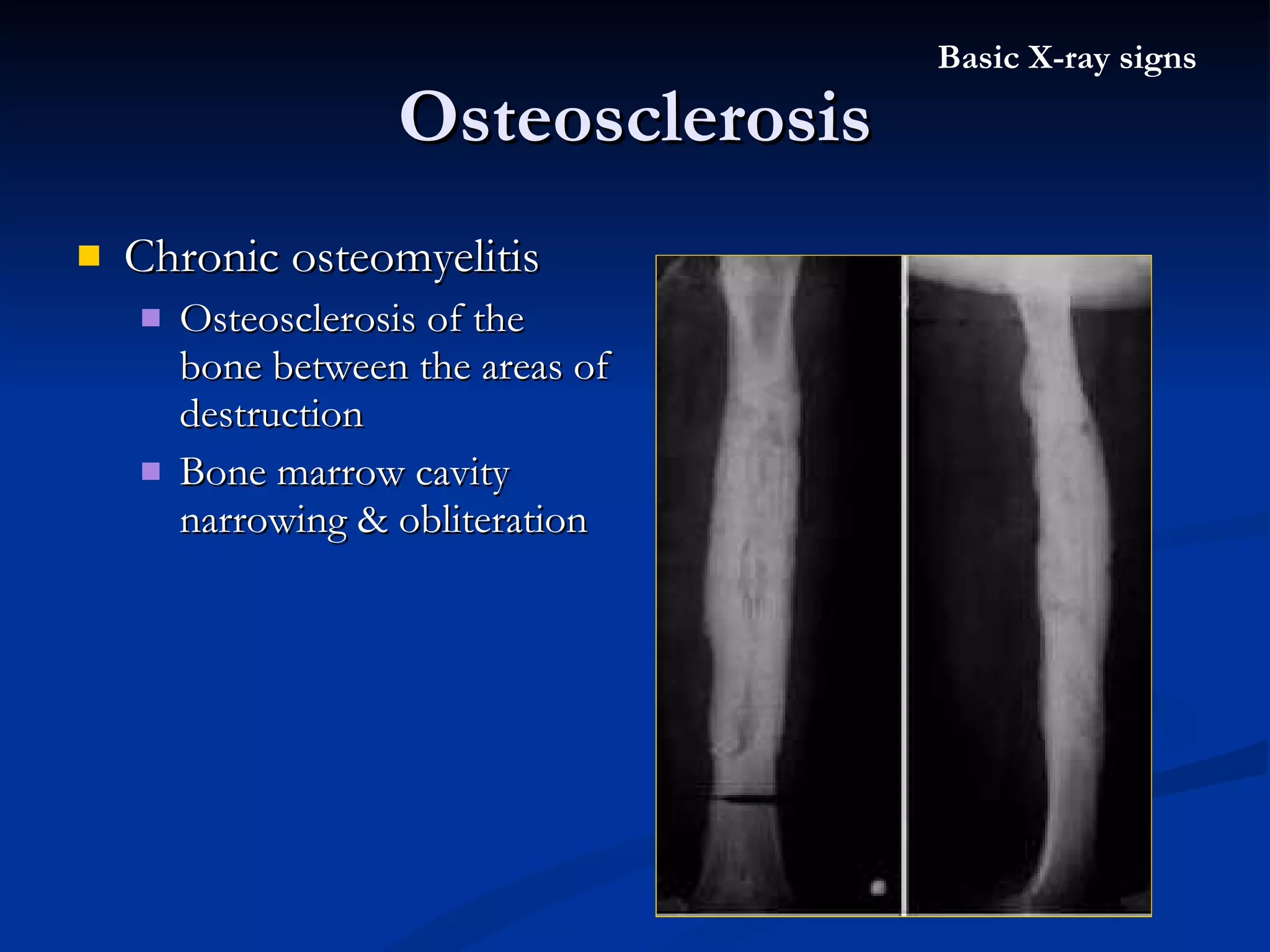 Chronic osteomyelitis  Osteosclerosis of the bone between the areas of destruction Bone marrow cavity narrowing & obliteration Osteosclerosis Basic X-ray signs 