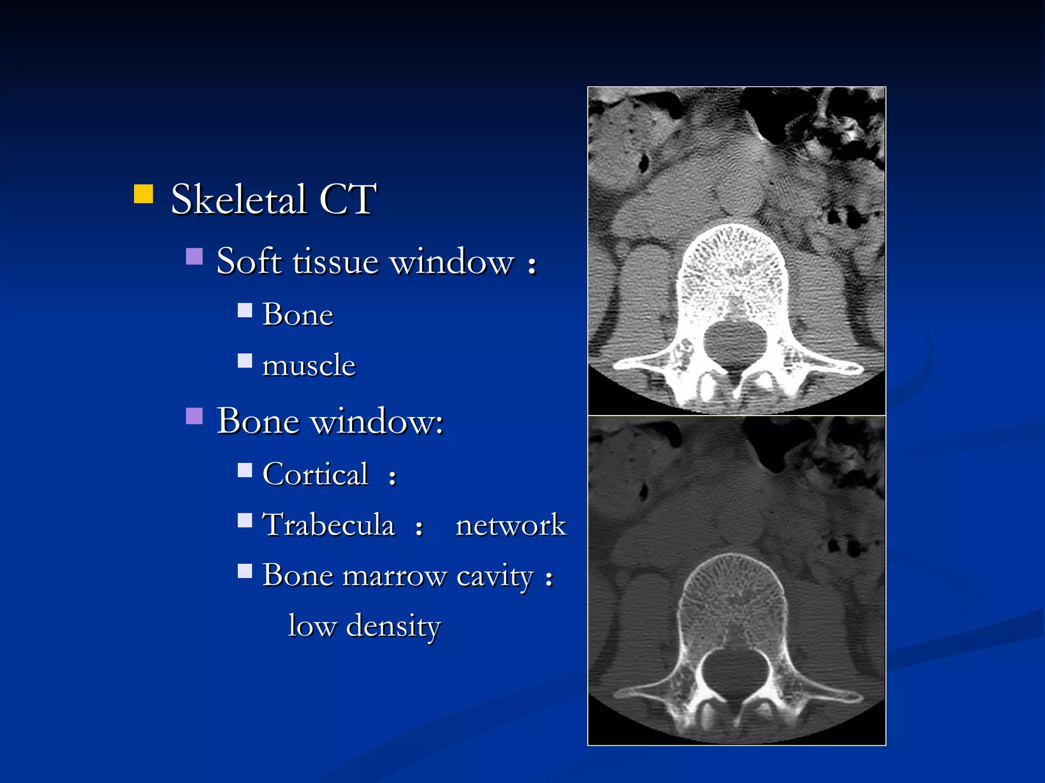 Skeletal CT Soft tissue window ： Bone muscle Bone window: Cortical  ： Trabecula  ： network Bone marrow cavity ： low density 