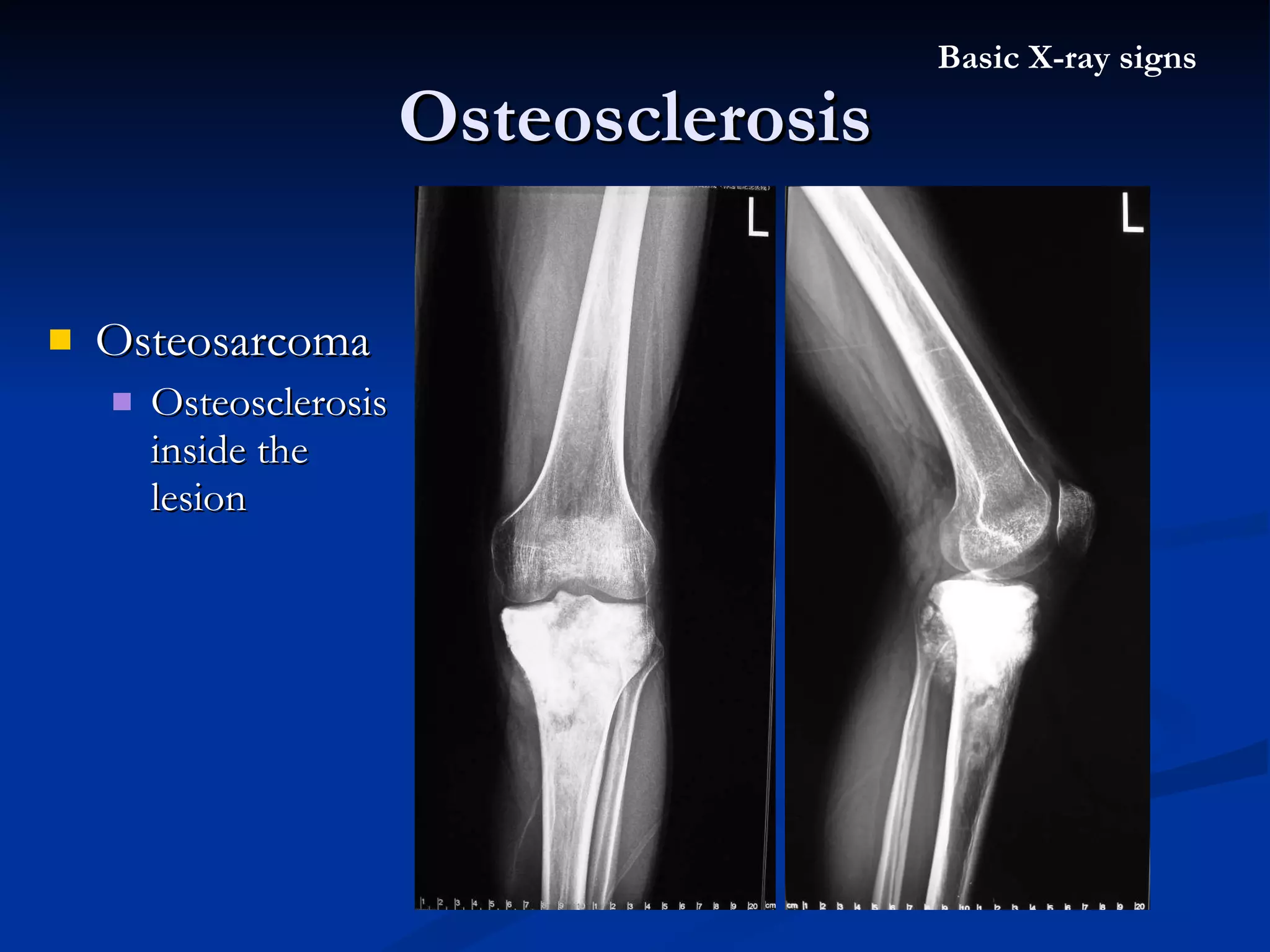 Osteosarcoma  Osteosclerosis inside the lesion Osteosclerosis Basic X-ray signs 