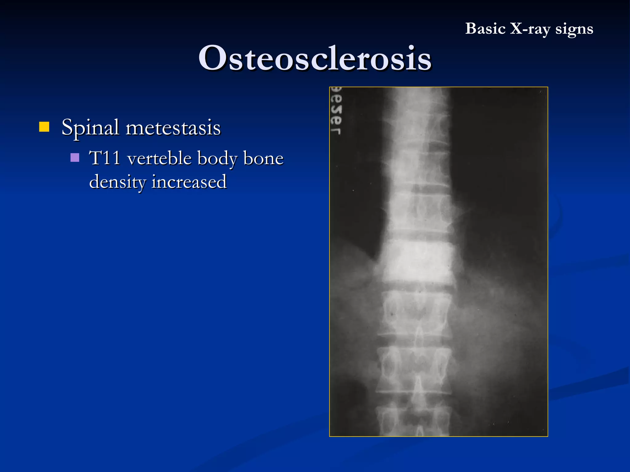 Spinal metestasis T11 verteble body bone density increased Osteosclerosis Basic X-ray signs 