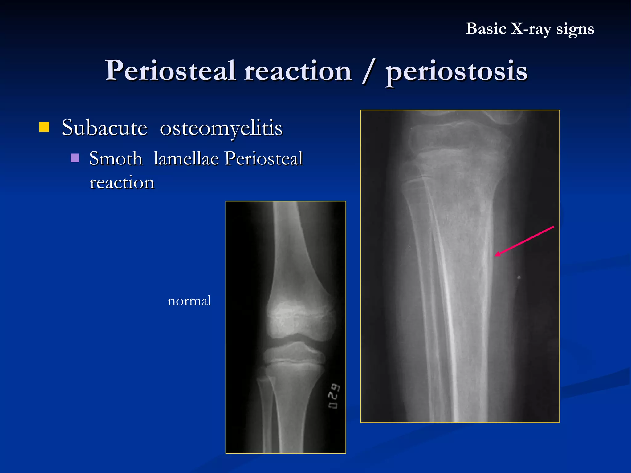 Subacute  osteomyelitis Smoth  lamellae Periosteal reaction  Periosteal reaction / periostosis Basic X-ray signs normal 
