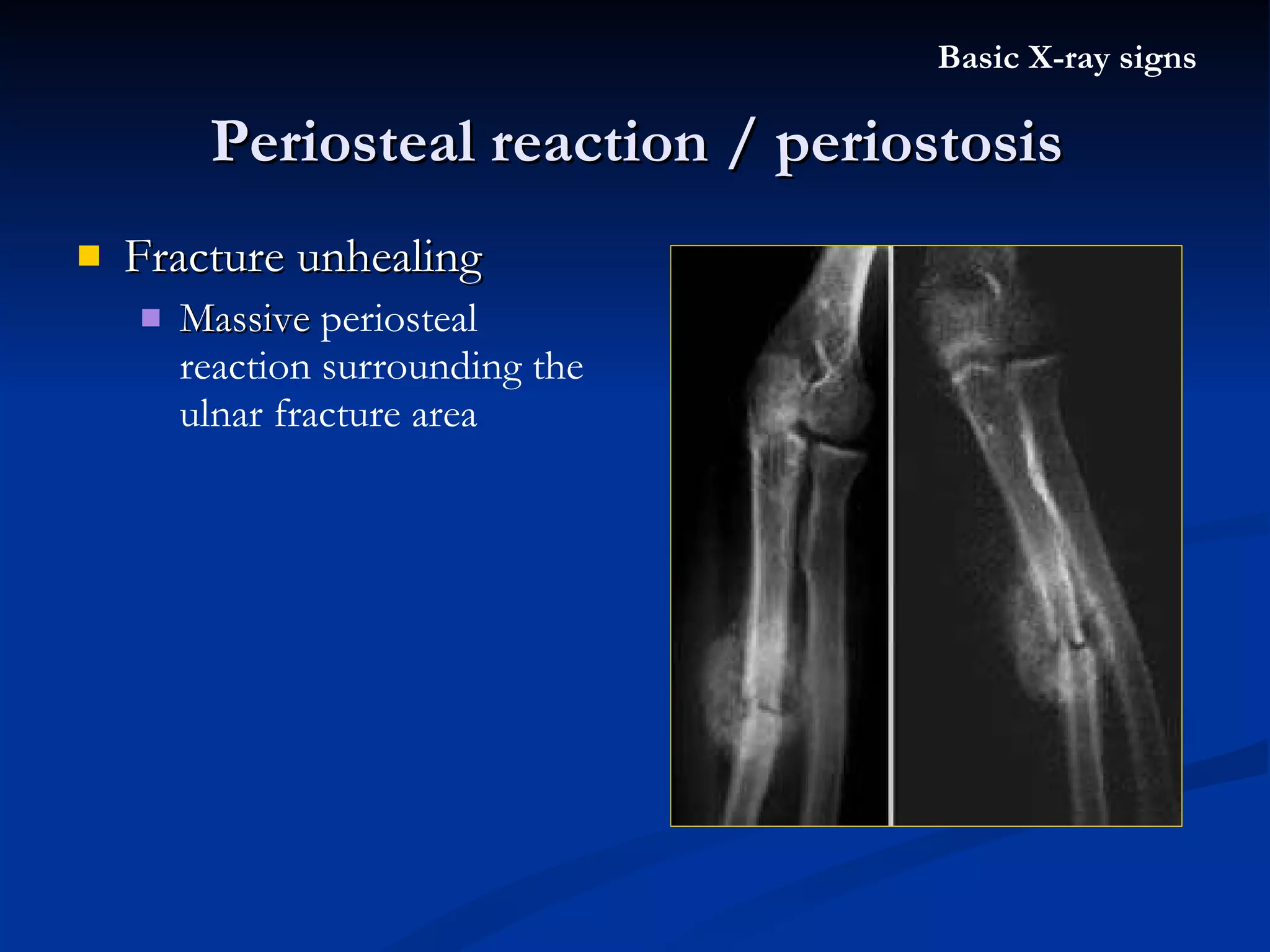 Fracture unhealing Massive  periosteal reaction surrounding the ulnar fracture area Periosteal reaction / periostosis Basic X-ray signs 