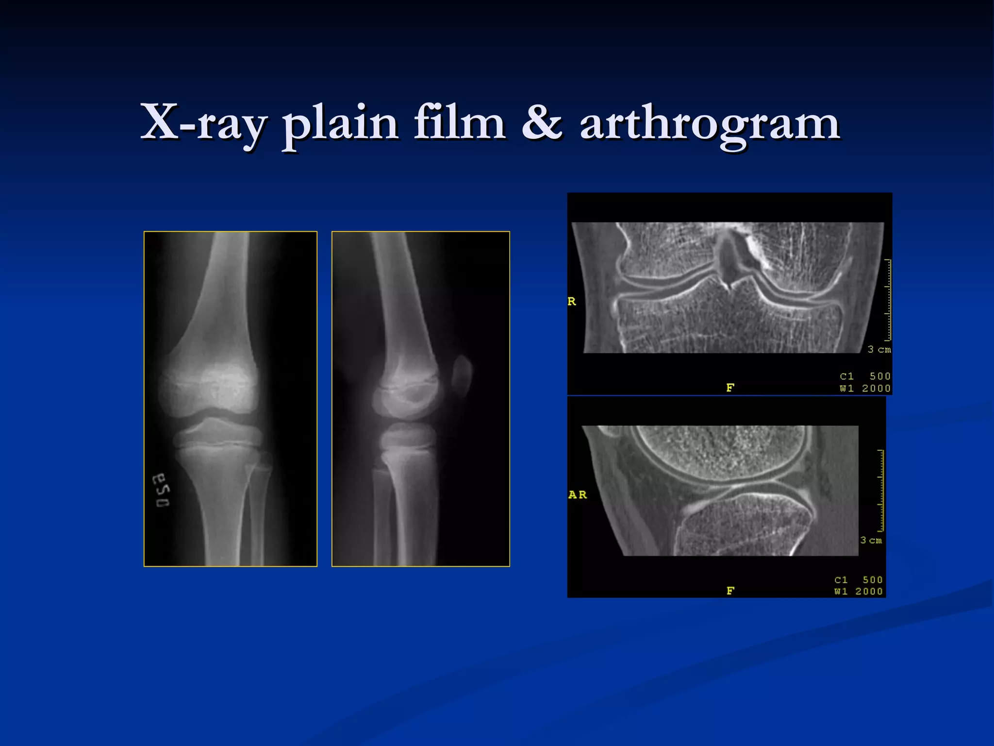 X-ray plain film & arthrogram 