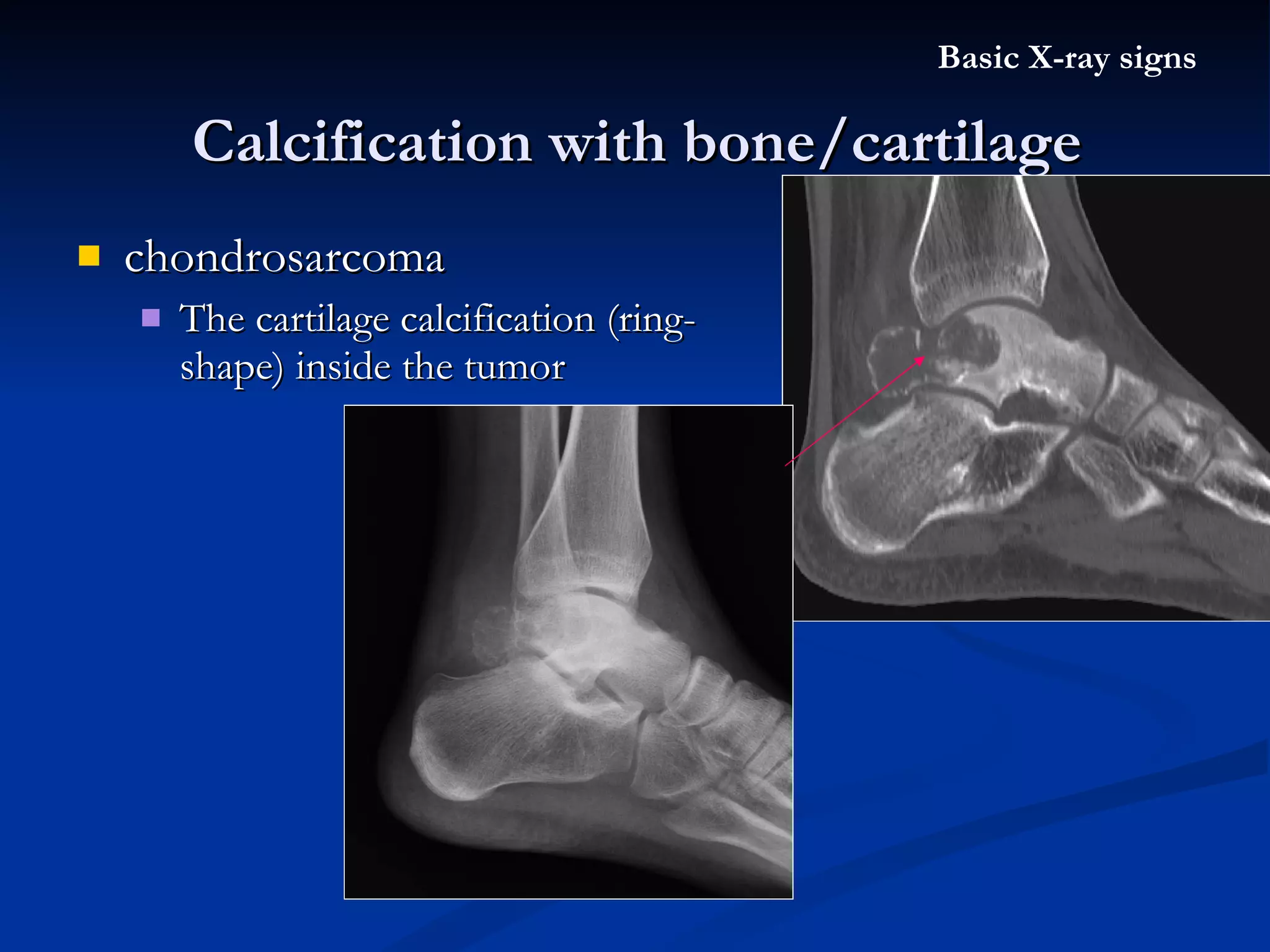chondrosarcoma The cartilage calcification (ring-shape) inside the tumor Calcification with bone/cartilage Basic X-ray signs 