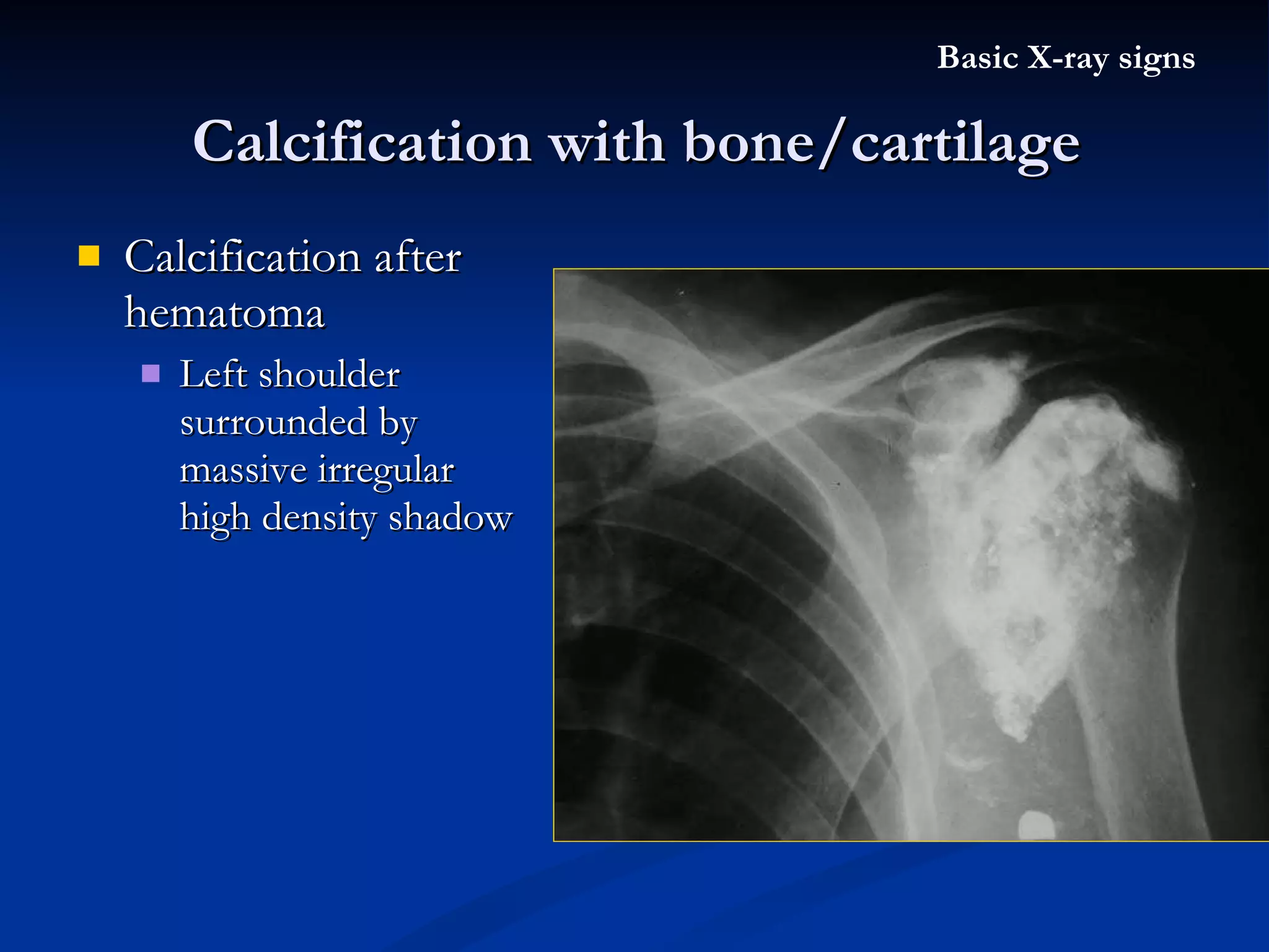Calcification after hematoma Left shoulder surrounded by massive irregular high density shadow Calcification with bone/cartilage Basic X-ray signs 