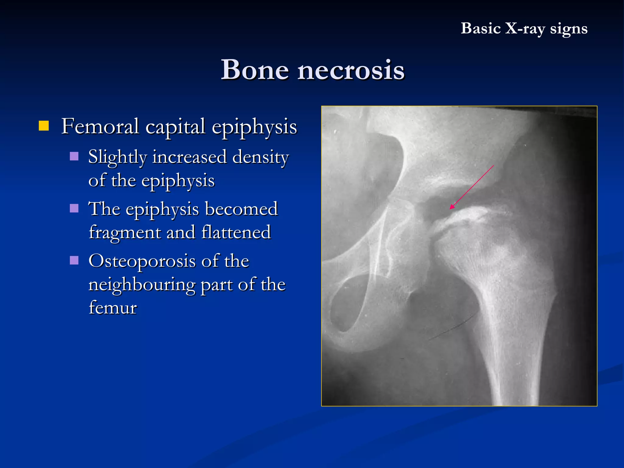 Femoral capital epiphysis Slightly increased density of the epiphysis The epiphysis becomed fragment and flattened Osteoporosis of the neighbouring part of the femur Bone necrosis Basic X-ray signs 
