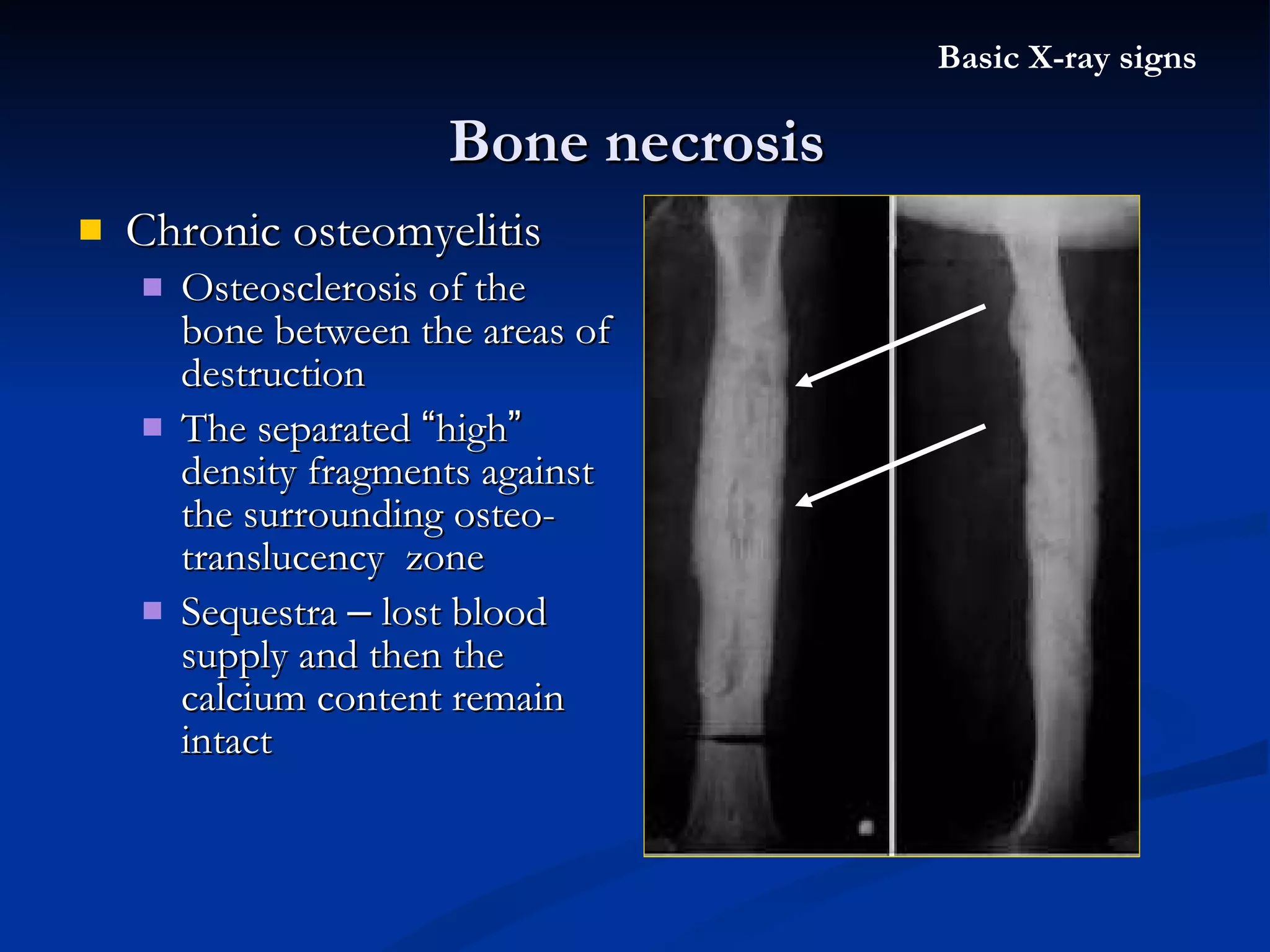 Chronic osteomyelitis  Osteosclerosis of the bone between the areas of destruction The separated  “ high ”  density fragments against the surrounding osteo-translucency  zone Sequestra  –  lost blood supply and then the calcium content remain intact Bone necrosis Basic X-ray signs 