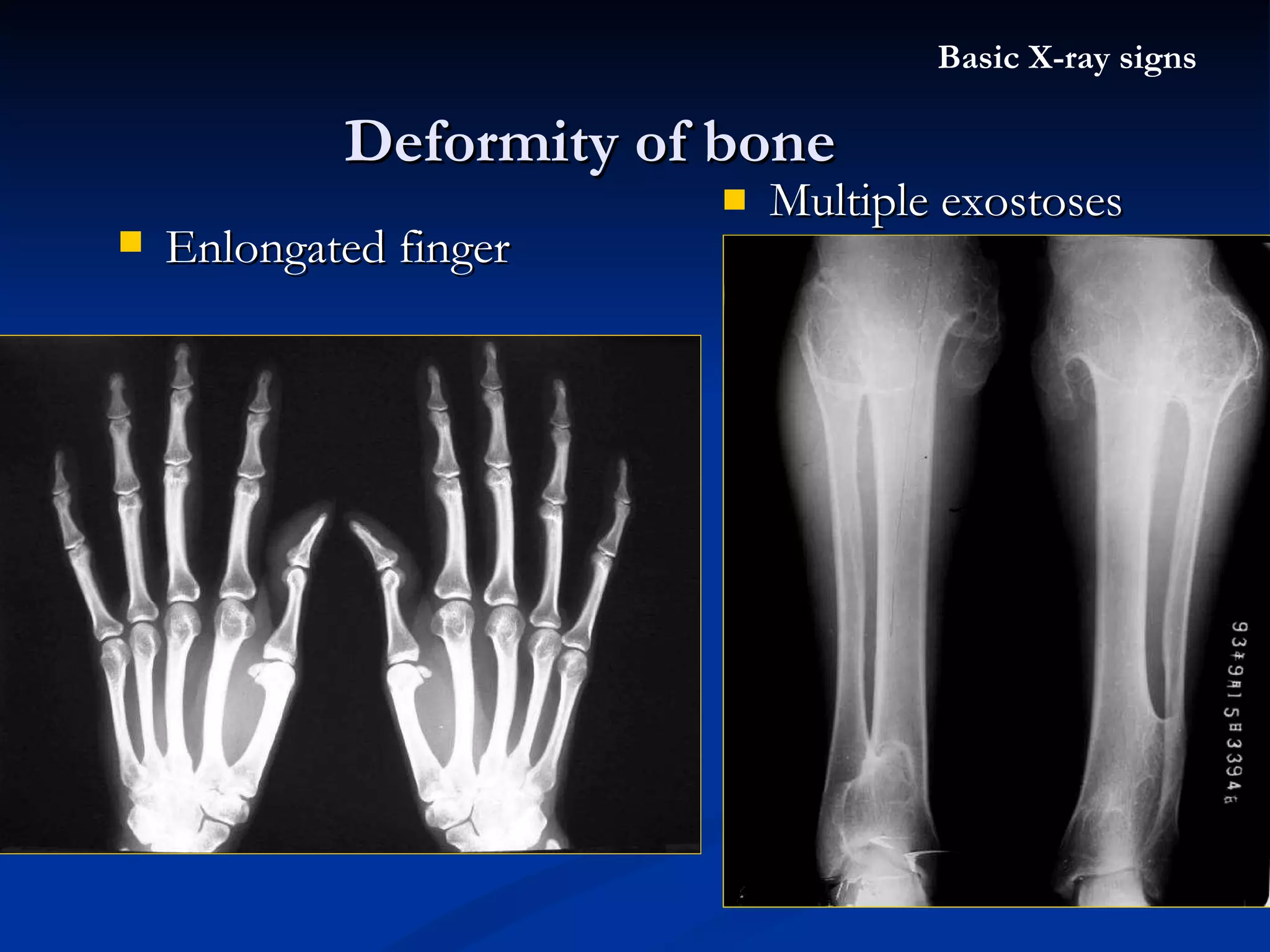 Multiple exostoses Deformity of bone Basic X-ray signs Enlongated finger 