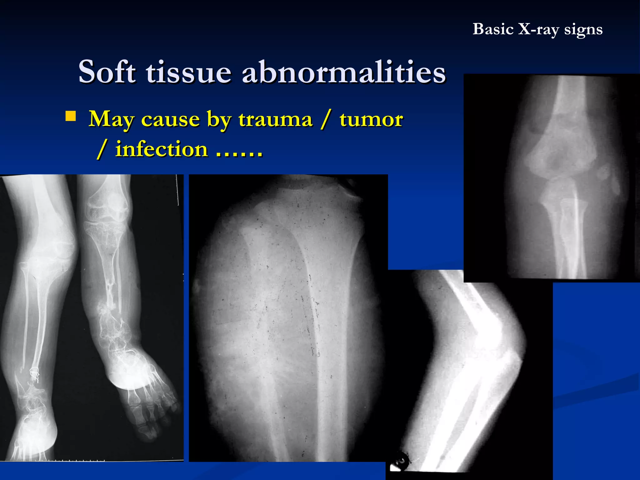 Soft tissue abnormalities Basic X-ray signs May cause by trauma / tumor / infection  …… 