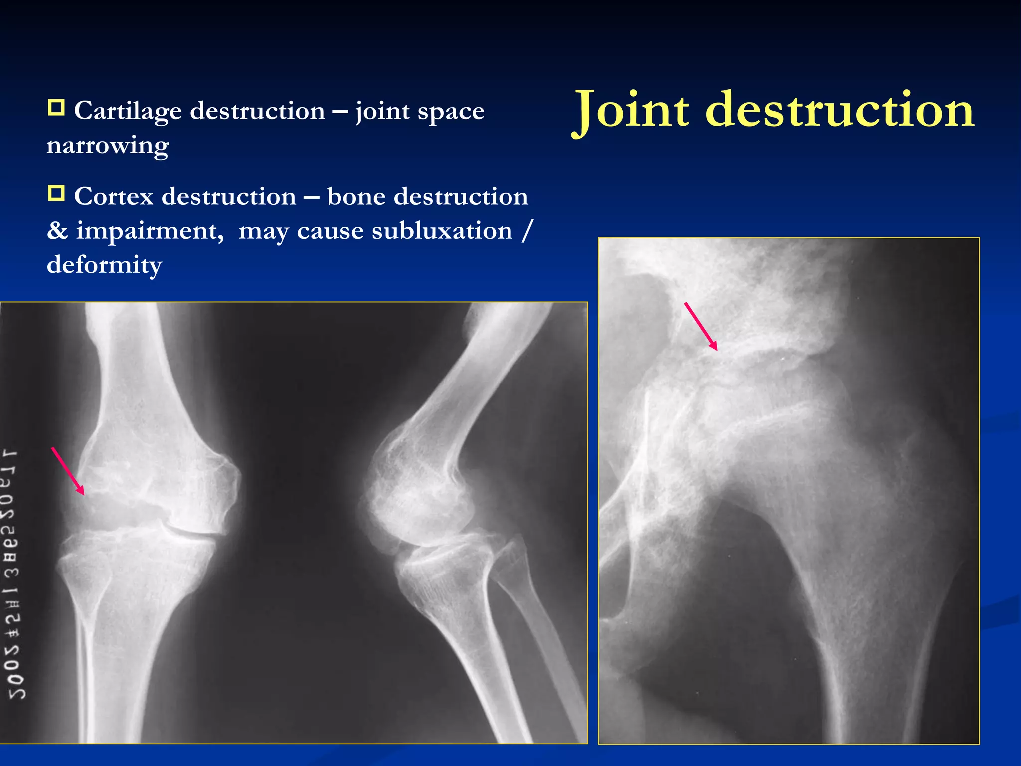Joint destruction Cartilage destruction  –  joint space narrowing Cortex destruction  –  bone destruction & impairment,  may cause subluxation / deformity 