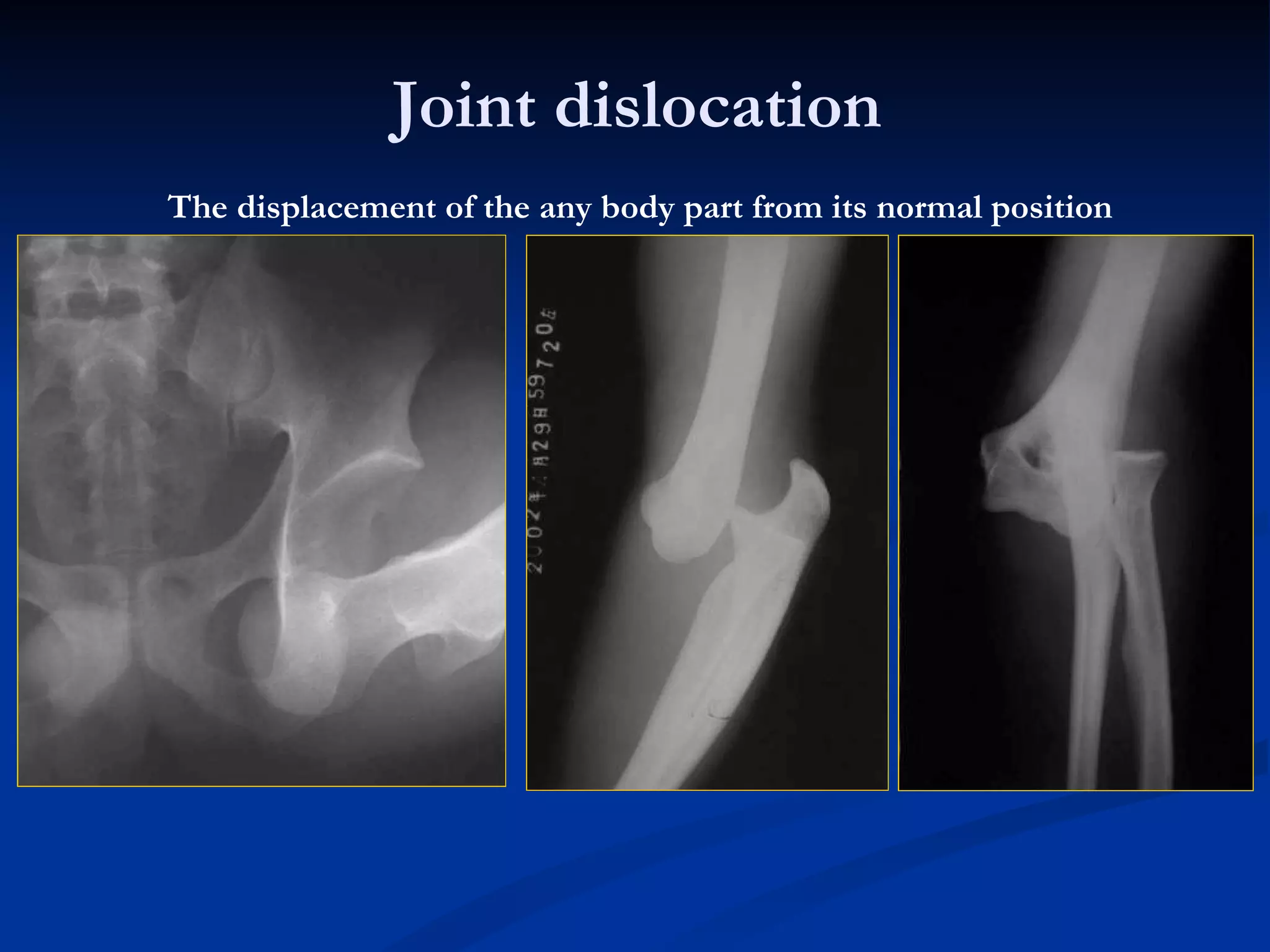 Joint dislocation The displacement of the any body part from its normal position 