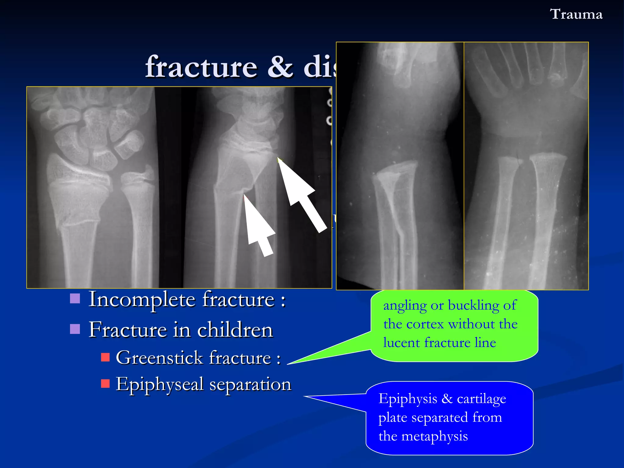 X-ray ： Fracture line ： the break of bone shows a irregular translucent line Transverse fracture / oblique fracture / spiral fracture Comprese fracture Comminution fracture ( ＞ 2) / segmental fracture Incomplete fracture :  Fracture in children Greenstick fracture :  Epiphyseal separation fracture & dislocation  Trauma angling or buckling of the cortex without the lucent fracture line Epiphysis & cartilage plate separated from the metaphysis 