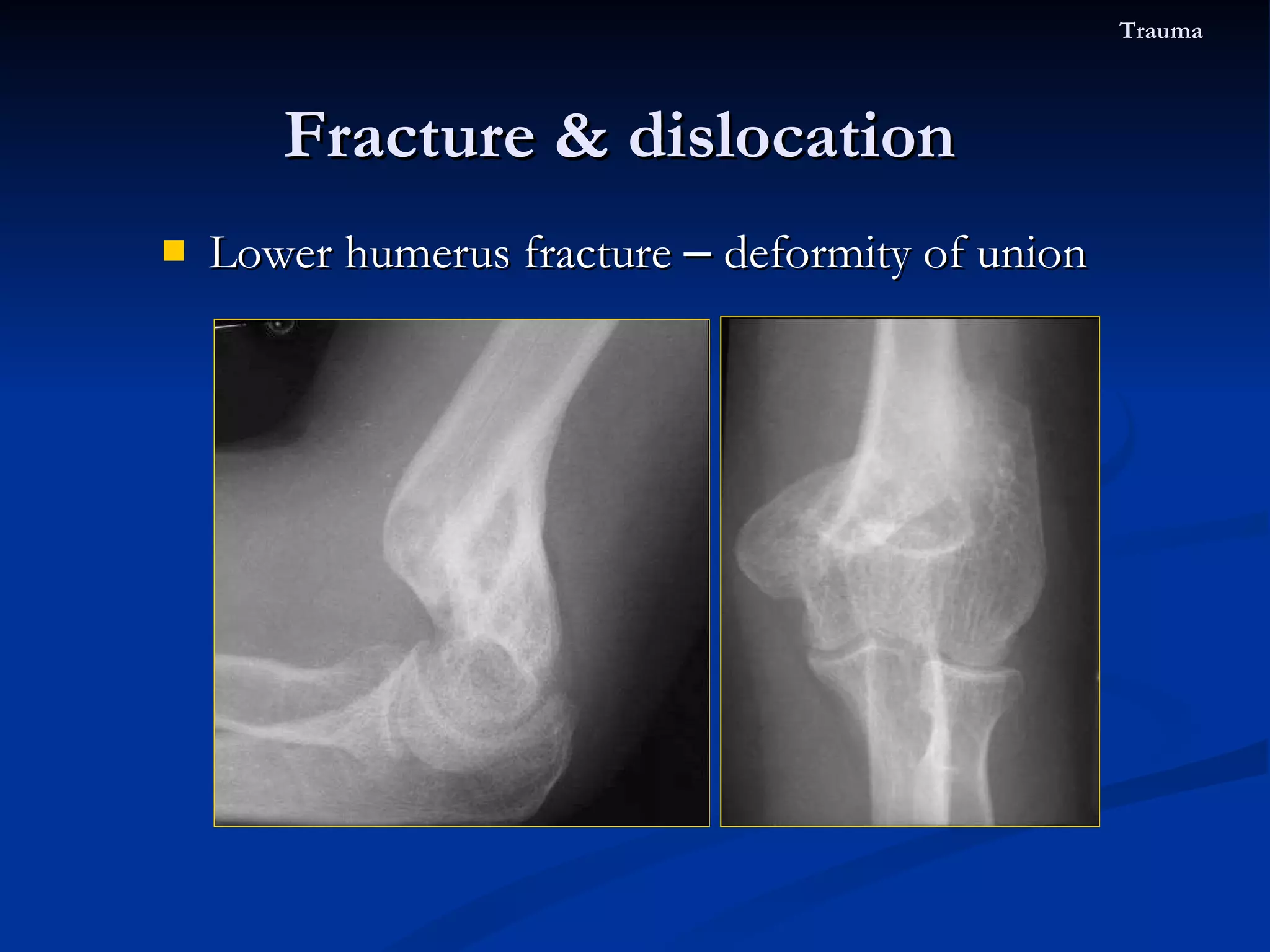 Lower humerus fracture  –  deformity of union Fracture & dislocation  Trauma 