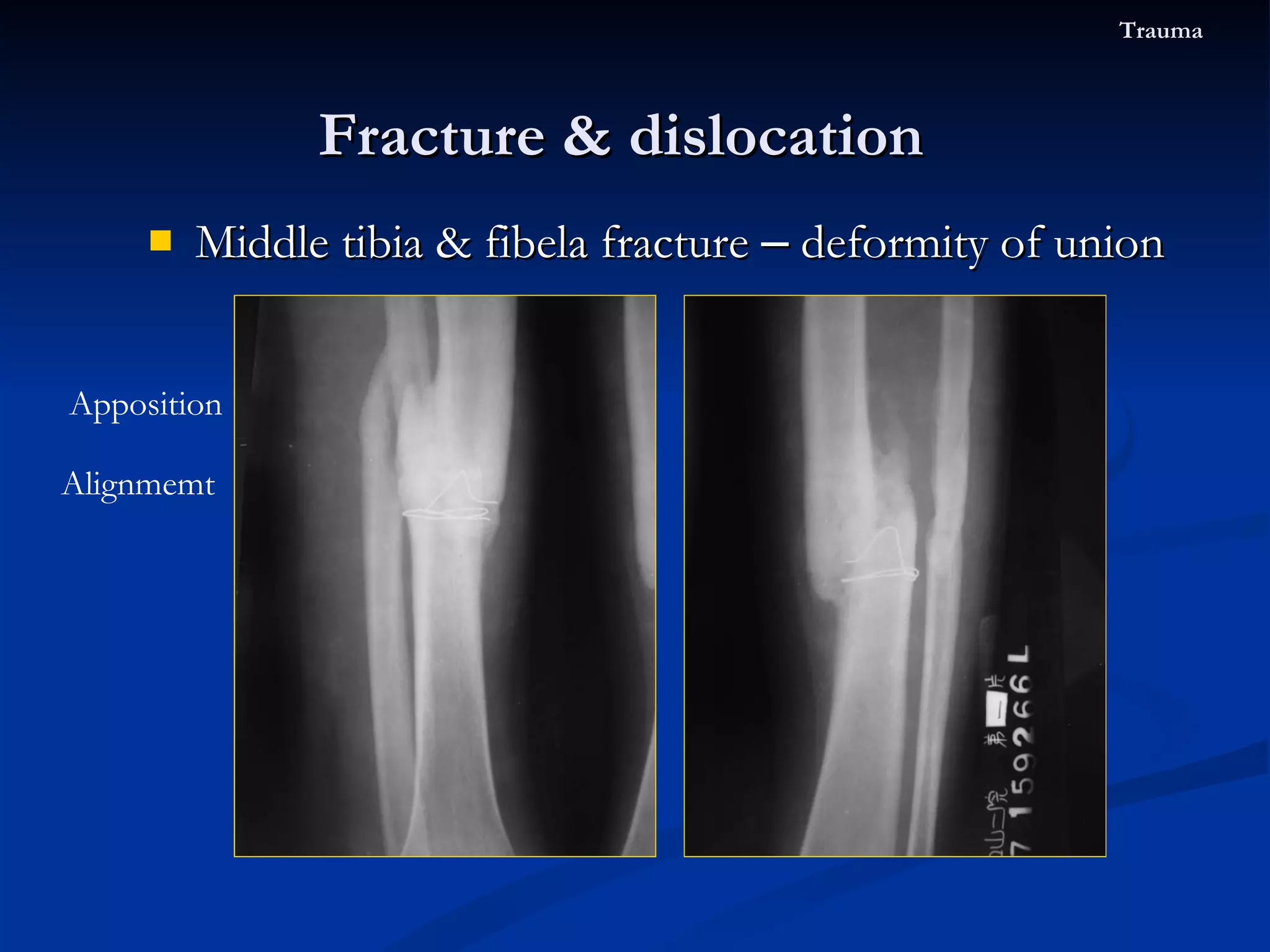 Middle tibia & fibela fracture  –  deformity of union Fracture & dislocation  Trauma Apposition Alignmemt 
