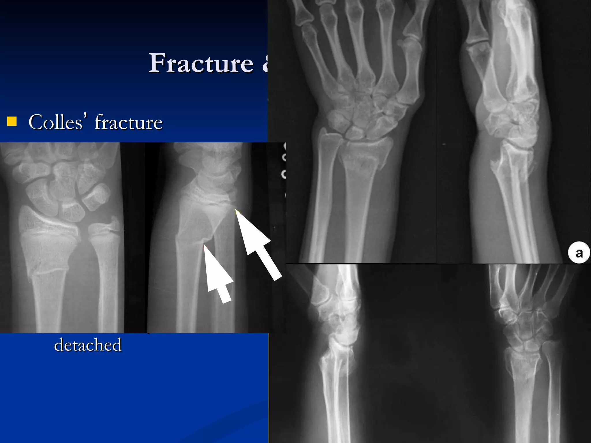 Colles ’  fracture A transverse fracture  through the distal radius With dorsal displacement & angulation of the distal radial fragment Malalignment as  “ silver fork ”   deformity The ulnar styloid is often detached Fracture & dislocation  Trauma 