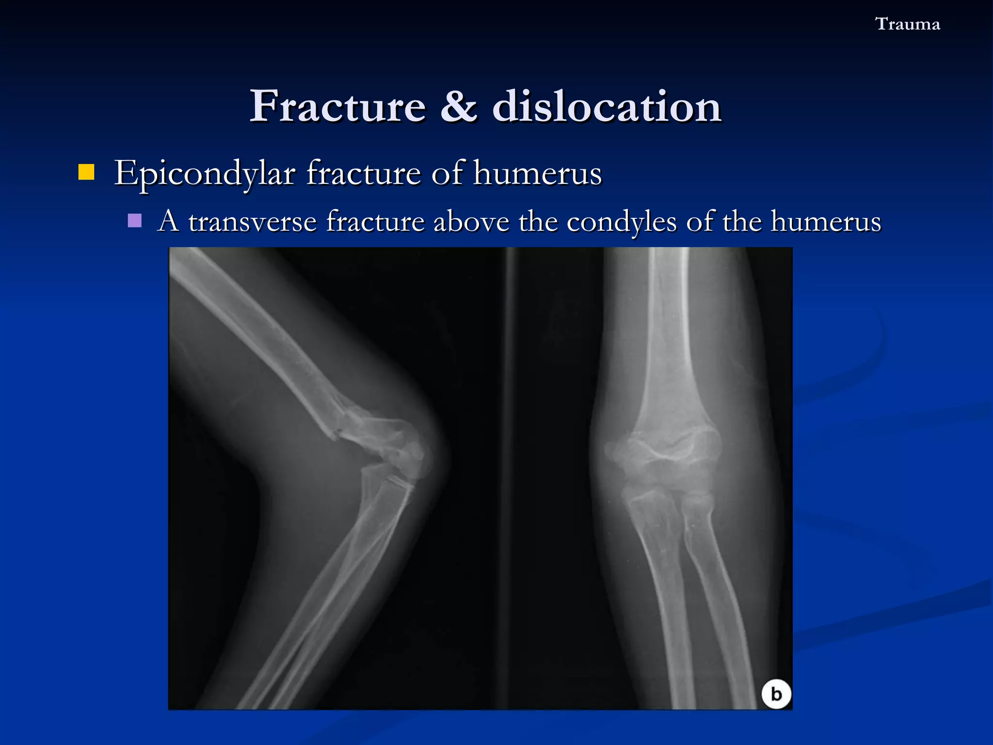 Epicondylar fracture of humerus A transverse fracture above the condyles of the humerus Fracture & dislocation  Trauma 