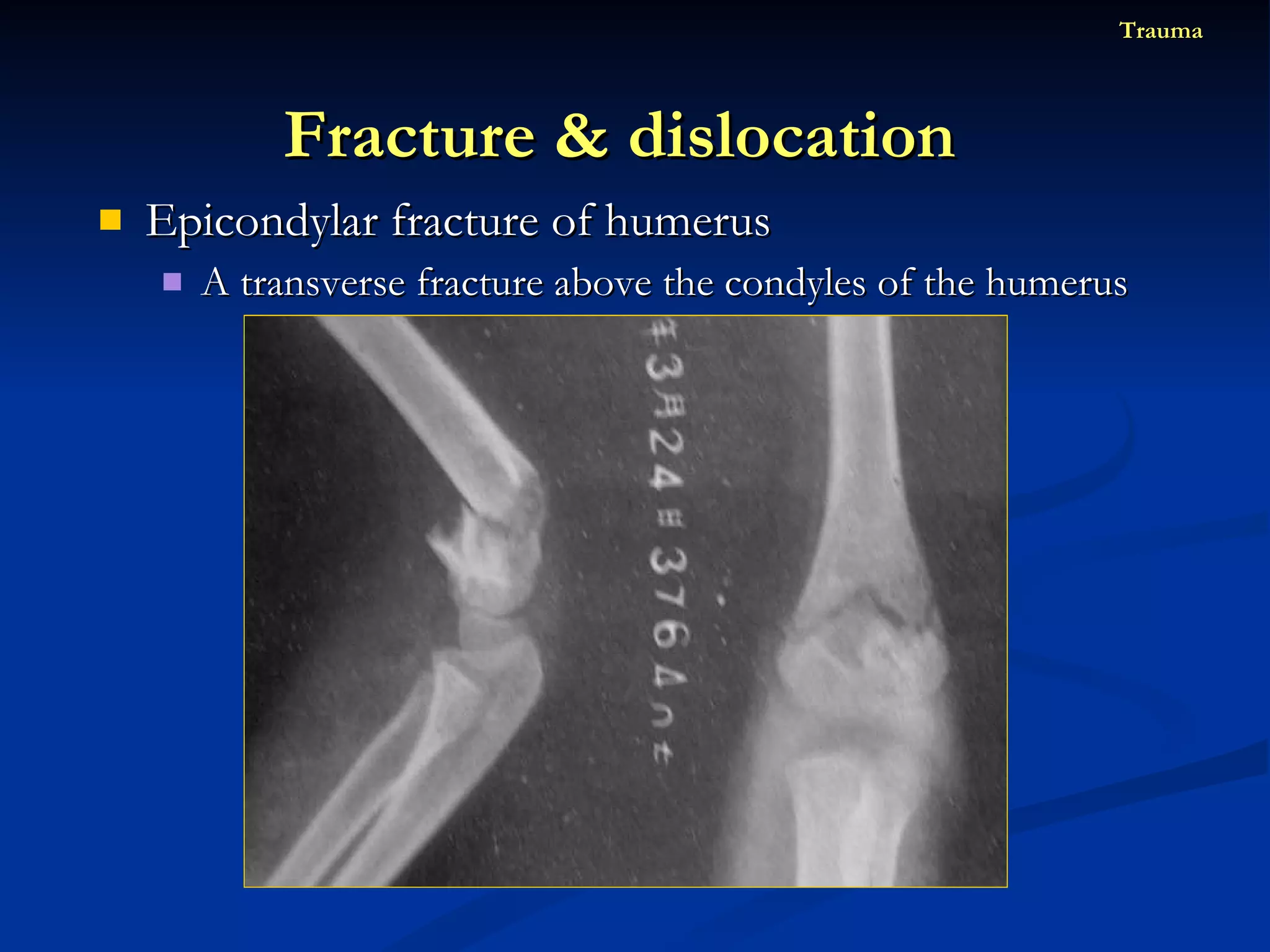 Epicondylar fracture of humerus A transverse fracture above the condyles of the humerus Fracture & dislocation  Trauma 