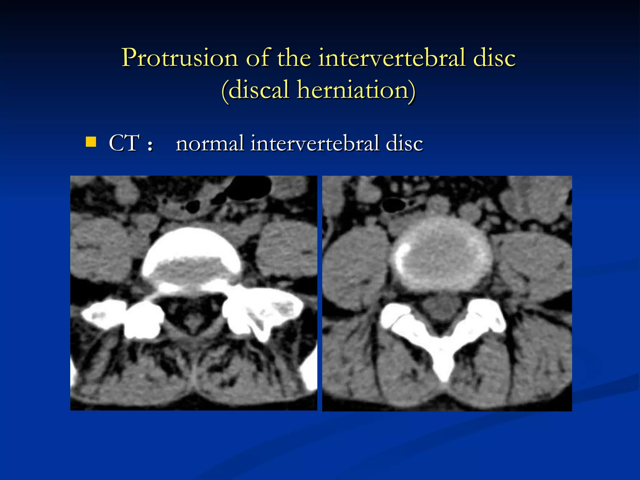 CT ： normal intervertebral disc Protrusion of the intervertebral disc (discal herniation) 