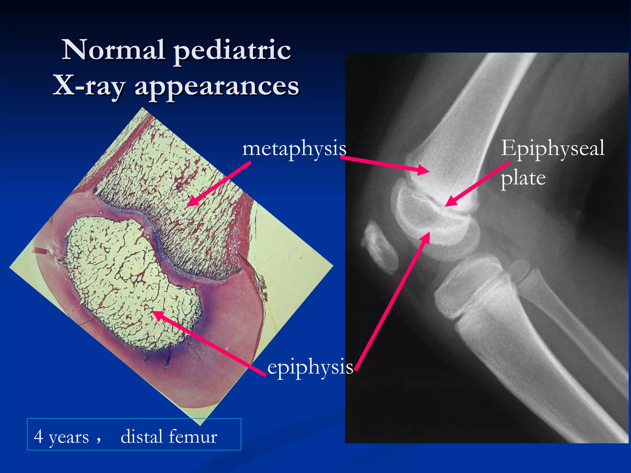 Normal pediatric X-ray appearances 4 years ， distal femur metaphysis epiphysis Epiphyseal plate 