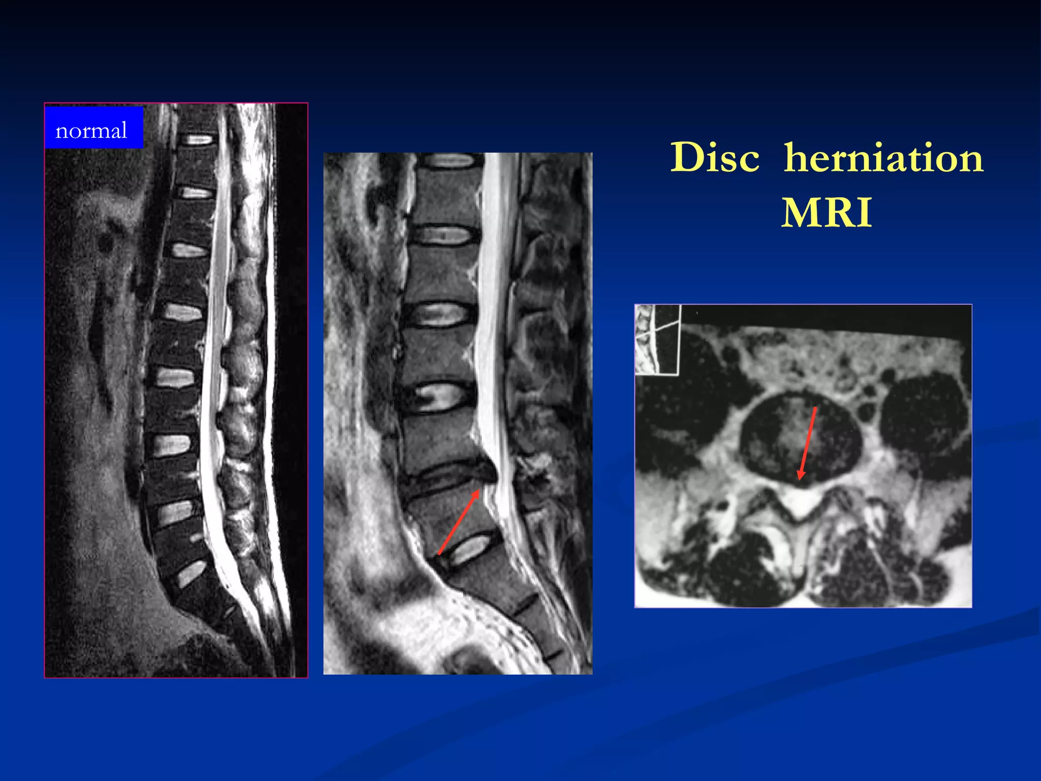 Disc  herniation MRI normal 