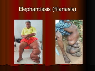 Elephantiasis (filariasis) 