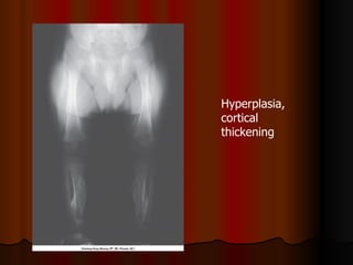 Hyperplasia, cortical thickening 