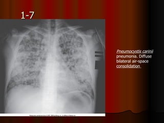 1-7 Pneumocystis carinii  pneumonia. Diffuse bilateral air-space  consolidation  
