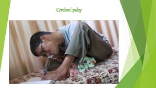 Cerebral palsy
 