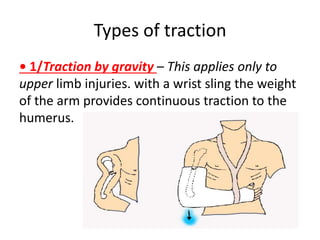 Types of traction
• 1/Traction by gravity – This applies only to
upper limb injuries. with a wrist sling the weight
of the arm provides continuous traction to the
humerus.
 