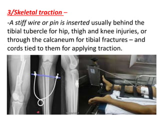 3/Skeletal traction –
-A stiff wire or pin is inserted usually behind the
tibial tubercle for hip, thigh and knee injuries, or
through the calcaneum for tibial fractures – and
cords tied to them for applying traction.
 