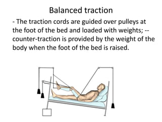 Balanced traction
- The traction cords are guided over pulleys at
the foot of the bed and loaded with weights; --
counter-traction is provided by the weight of the
body when the foot of the bed is raised.
 