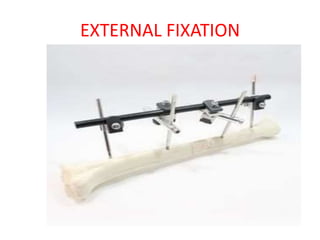 EXTERNAL FIXATION
 